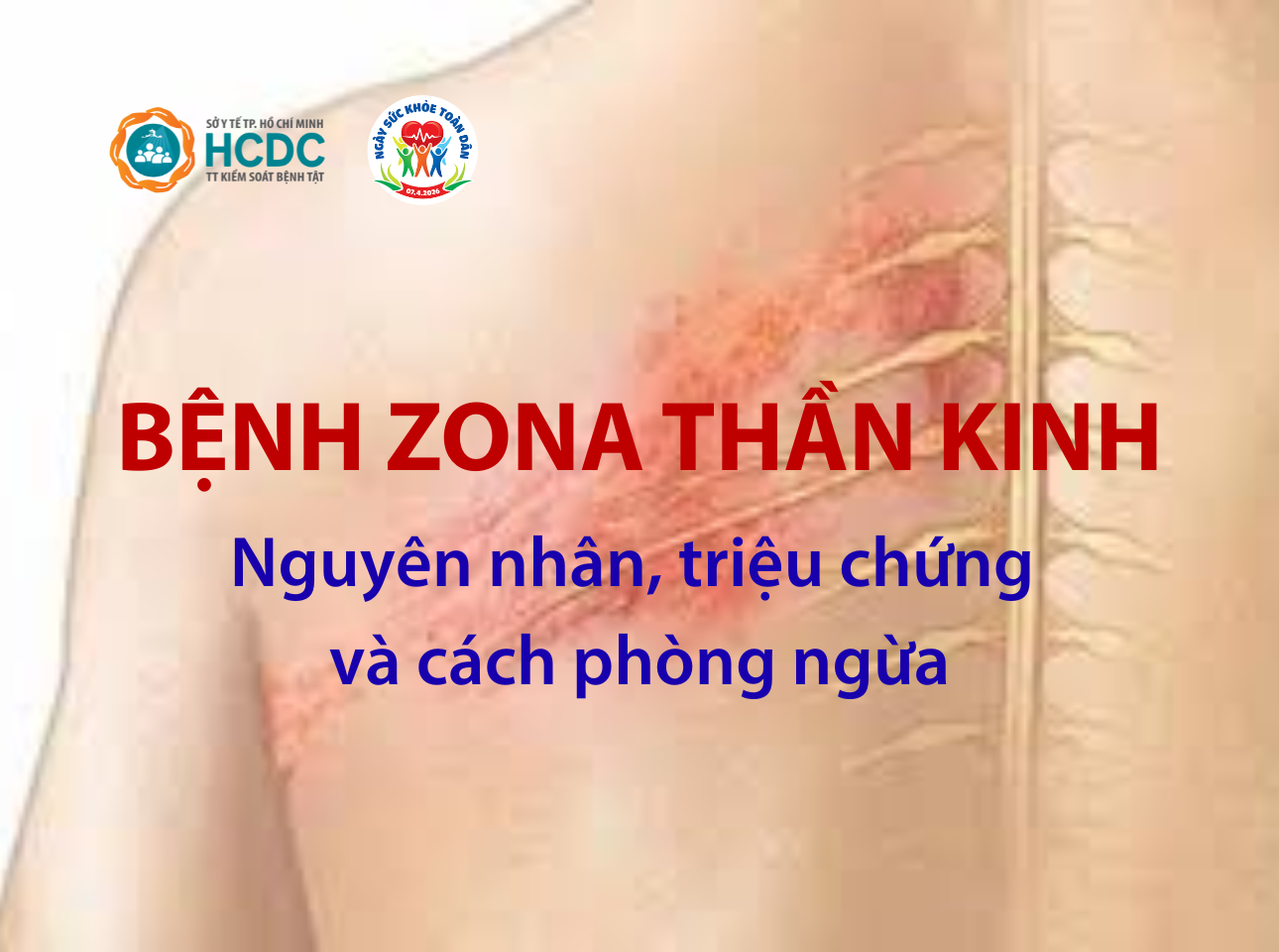 Bệnh Zona thần kinh: Nguyên nhân, triệu chứng và cách phòng ngừa