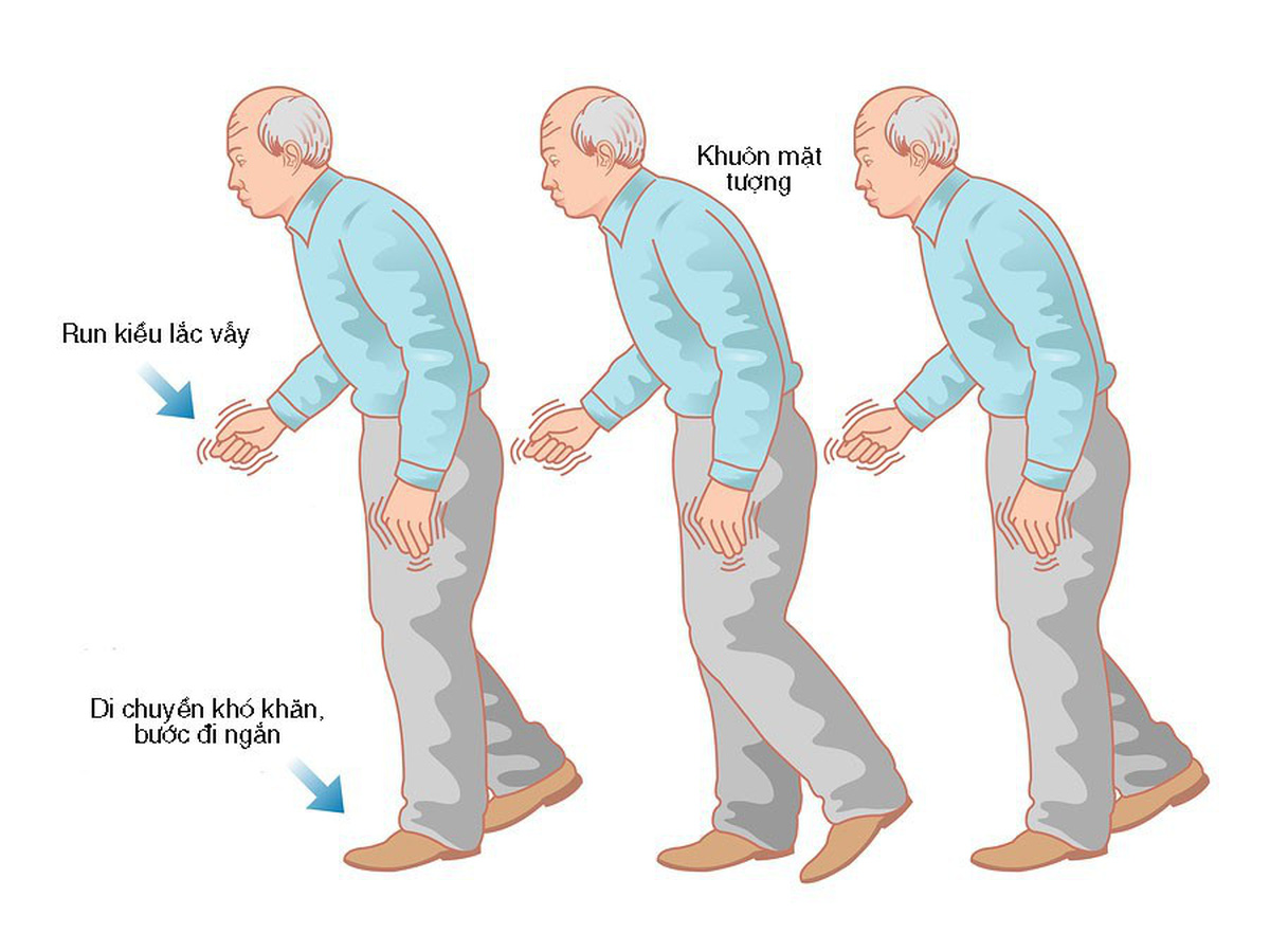 10 ĐIỀU NÊN LÀM Ở BỆNH NHÂN PARKINSON