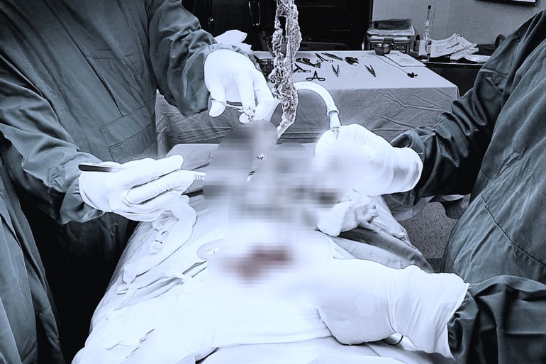 Cảnh giác hành vi tự ăn tóc ở trẻ em