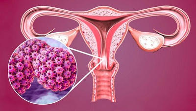 Mối liên quan giữa HPV và HIV