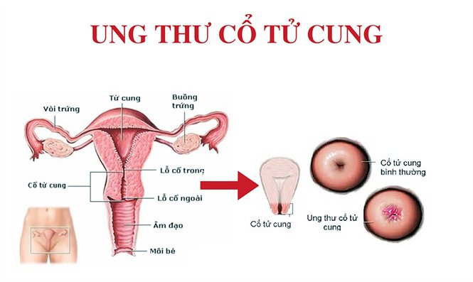 Những yếu tố nguy cơ của Ung thư cổ tử cung