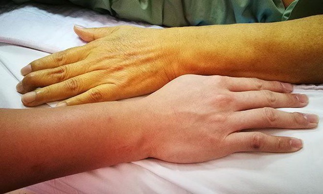 Ung thư đường mật: Vàng da là triệu chứng thường gặp (phần 1)