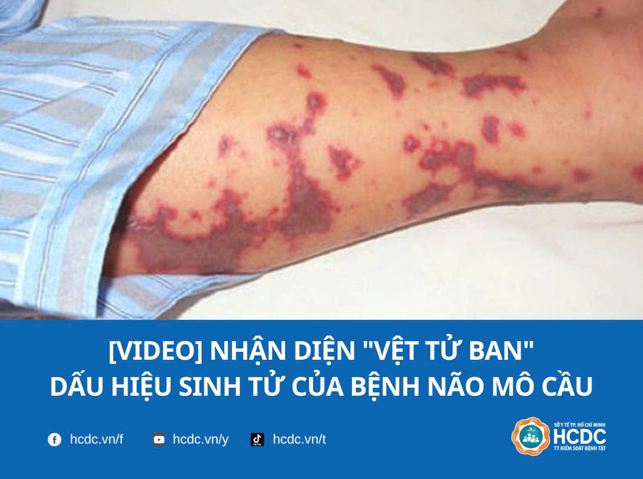 [Video] Nhận diện "Vệt tử ban" – Dấu hiệu sinh tử của bệnh Não mô cầu
